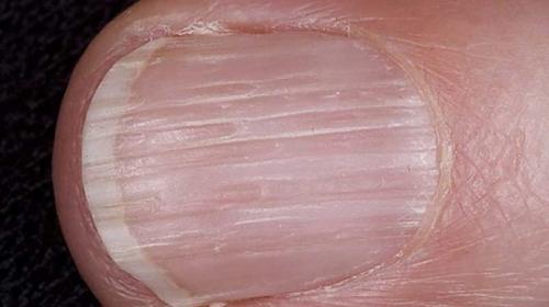 Точечные углубления на ногтях. 5 главных причин возникновения борозд на ногтях