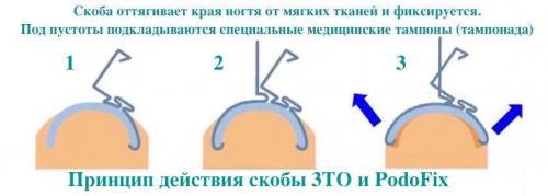 Титановые ногти, что это значит. Реальные отзывы о Титановых нитях на ногти