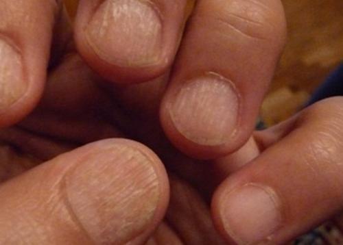 Бугристые ногти на больших пальцах рук. Что представляют собой волнистые ногти, их виды