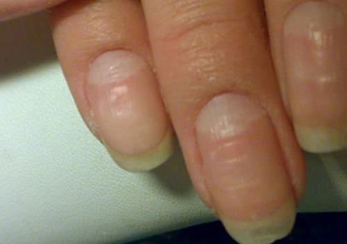 Из-за чего ногти становятся ребристыми и что делать в этом случае
