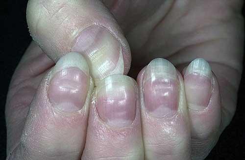Почему бугристые ногти. Волнистые ногти на больших пальцах рук: причины