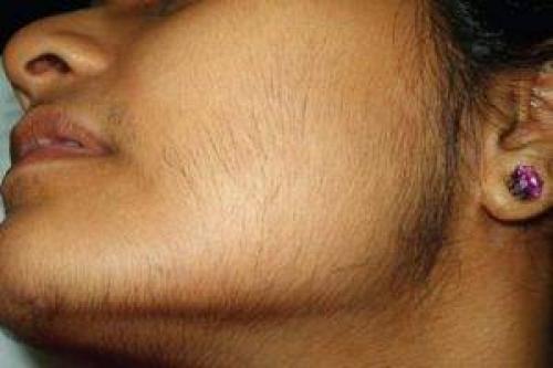 От чего растут волосы на лице у женщин, что делать. Понятие и причины избыточной волосистости