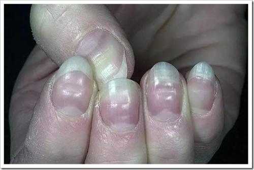 Как выровнять ногтевую пластину?