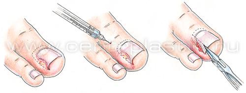 Что делать после маникюра. ПРИЧИНЫ И ЛЕЧЕНИЕ ВОСПАЛЕНИЯ КУТИКУЛЫ