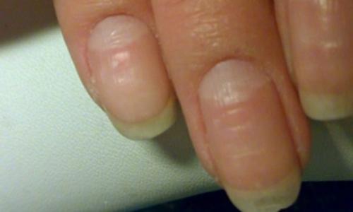 Поперечные бороздки на ногтях. 5 главных причин возникновения борозд на ногтях