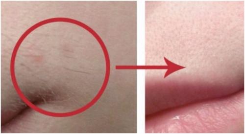 Как убрать пушок над верхней губой. Как убрать усики над губой? 01