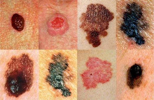 Родинки на лице опасность. Опасные и неопасные родинки