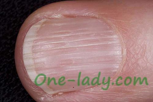 Как лечить волнистые ногти в домашних условиях. Почему ногти становятся волнистыми у детей и как лечить деформированные ногтевые пластины