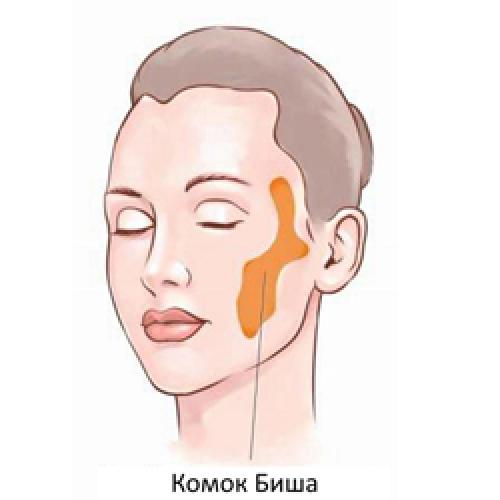 Комки Биша последствия в старости. Страшно красивые, чем чревато удаление комков Биша