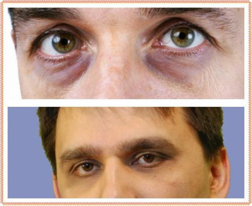 Как избавиться от синяков под глазами мужчине. Почему появляются синяки под глазами у мужчин: причина – проблемы со здоровьем