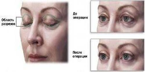 Как избавиться от кругов под глазами быстро. Как быстро избавиться от темных кругов под глазами за 2 дня 05 Как избавиться от кругов под глазами быстро. Как быстро избавиться от темных кругов под глазами за 2 дня 05