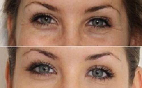 Как избавиться от кругов под глазами быстро. Как быстро избавиться от темных кругов под глазами за 2 дня 03 Как избавиться от кругов под глазами быстро. Как быстро избавиться от темных кругов под глазами за 2 дня 03