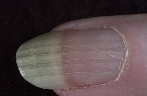 На ногтях дырочки. Причины и лечение наперстковидной (точечной) истыканности ногтей 09