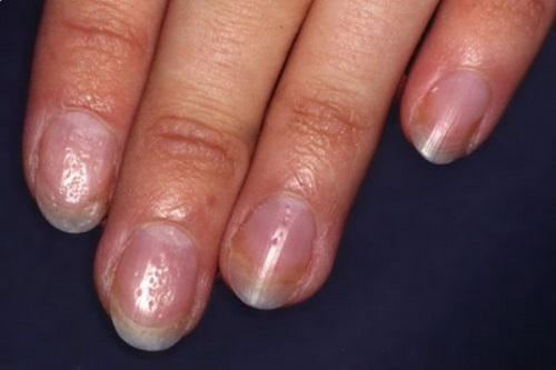 На ногтях дырочки. Причины и лечение наперстковидной (точечной) истыканности ногтей