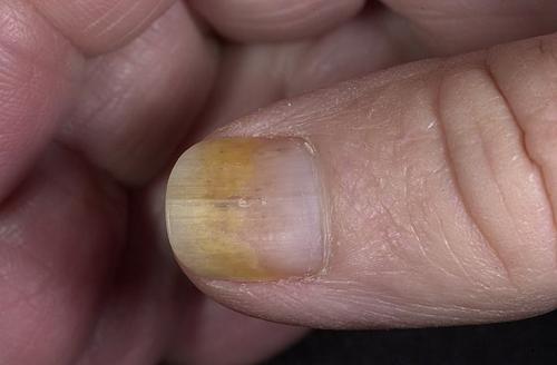 На ногтях дырочки. Причины и лечение наперстковидной (точечной) истыканности ногтей 11