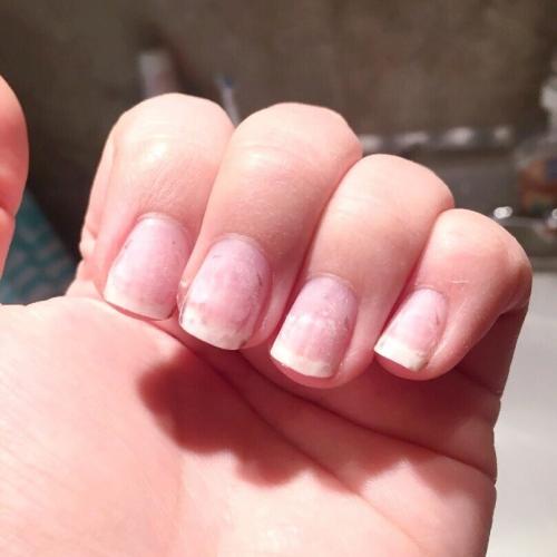 Ямки на ногтях после гель-лака. Почему после снятия гель-лака тонкие ногти: основные причины и способы восстановления