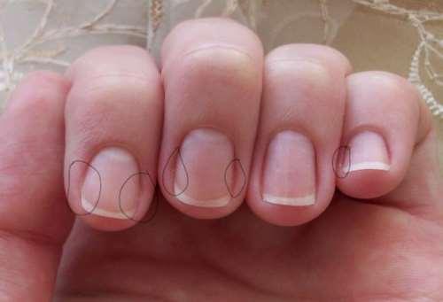 Заусенцы на пальцах: причины появления и лечение