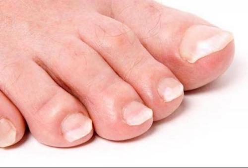 Точечные углубления на ногтях. Причины и лечение наперстковидной (точечной) истыканности ногтей 09 Точечные углубления на ногтях. Причины и лечение наперстковидной (точечной) истыканности ногтей 09