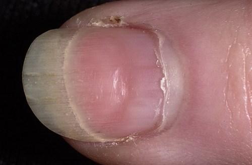 Поперечные бороздки на ногтях. Причины появления и лечение поперечных борозд на ногтях