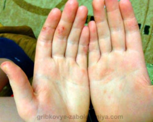 Грибок на пальцах рук около ногтей. Причины микоза на пальцах рук