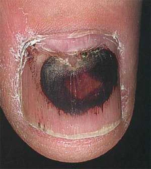 Красное пятно на ногте руки. Красные пятна на ногтях | Пятна 02 Красное пятно на ногте руки. Красные пятна на ногтях | Пятна 02