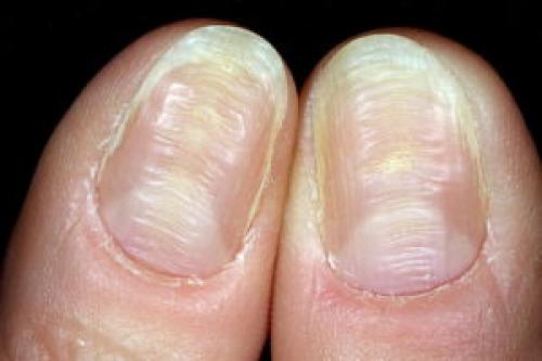 Бугристые ногти на больших пальцах ног. Почему ногти становятся бугристыми, не ровными