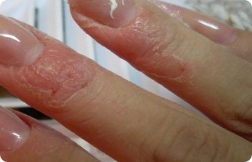 Почему сохнет кожа вокруг ногтей. Почему сильно сохнет кожа вокруг ногтей, грубеет на руках и ногах: причина 06