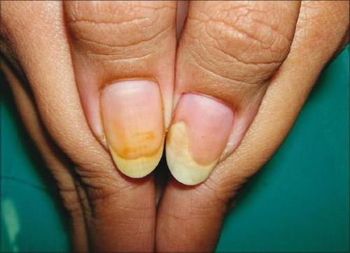 Почему сохнет кожа вокруг ногтей. Почему сильно сохнет кожа вокруг ногтей, грубеет на руках и ногах: причина 07