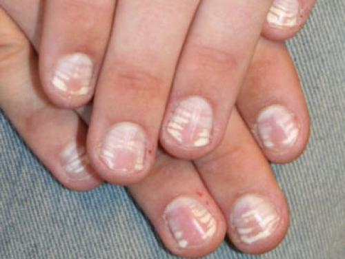 Черная полоса на ногте у ребенка. Полоски на ногтях