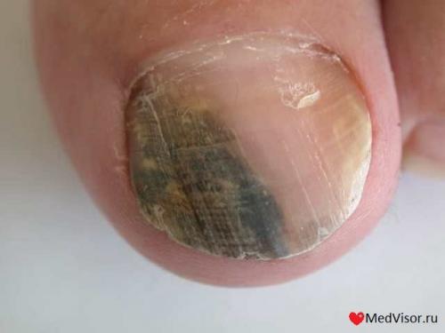 Вмятины на ногтях ног. Поперечные вмятины на ногтях. Откуда они берутся?