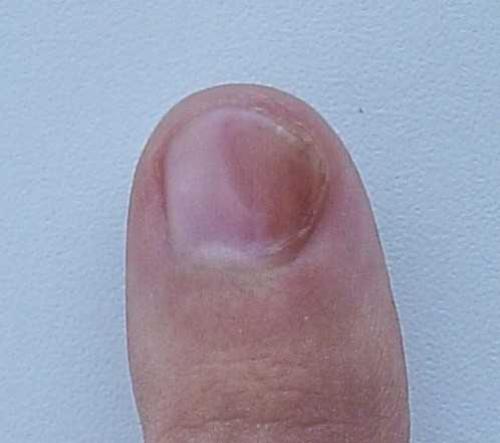 Механические повреждения ногтя