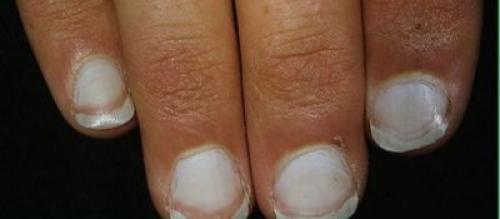 Изменения ногтей на руках. На что указывает изменение цвета
