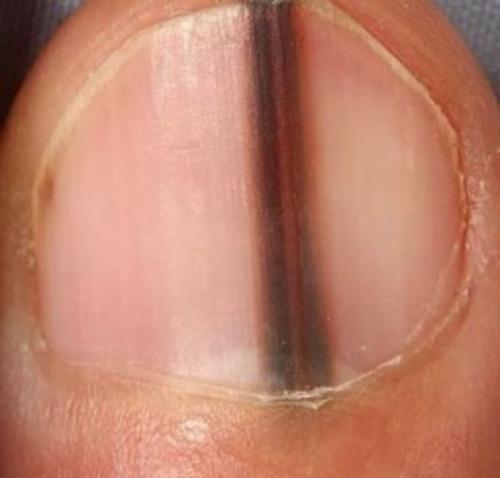 Изменения ногтей на руках. На что указывает изменение цвета