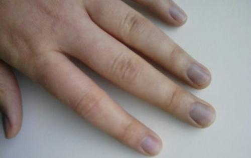 Изменения ногтей на руках. На что указывает изменение цвета