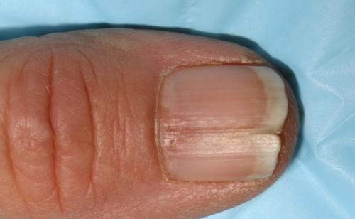 Под ногтями черные полоски, как заноза. Почему появляются дефекты