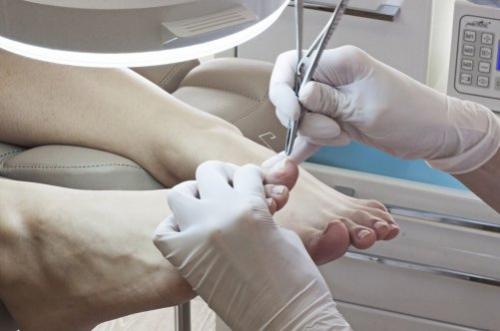 Лечение и причины наперстковидной истыканности ногтей