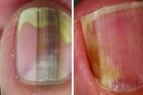 На ногтях рук впадины. Причины и лечение наперстковидной (точечной) истыканности ногтей 06 На ногтях рук впадины. Причины и лечение наперстковидной (точечной) истыканности ногтей 06