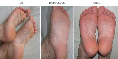 Носки-маска для ног, как пользоваться. Как действуют на кожу отшелушивающие носочки