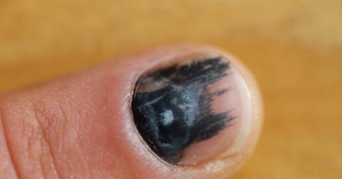 Черная полоса на ногте у ребенка. Полоски на ногтях