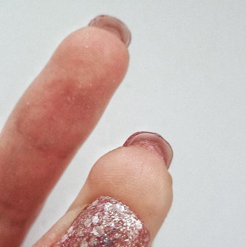 Нарастает кожа вокруг ногтей на ногах. Нарастает кожа под ногтем: что делать?