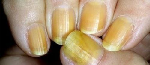 Изменения ногтей на руках. На что указывает изменение цвета