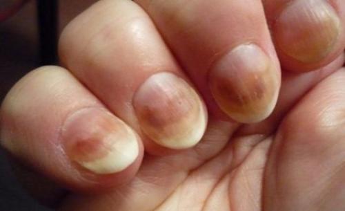 Почему сохнет кожа вокруг ногтей на руках после шеллака. 