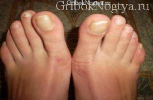 Темная кожа вокруг ногтей. Симптомы грибка, основные методы лечения