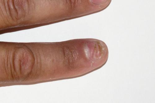 Бугристые ногти на больших пальцах ног. Почему ногти становятся бугристыми, не ровными 01