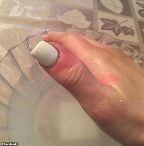 Тонкие коричневые полоски на ногтях. Полоска на ногте оказалась симптомом рака кожи