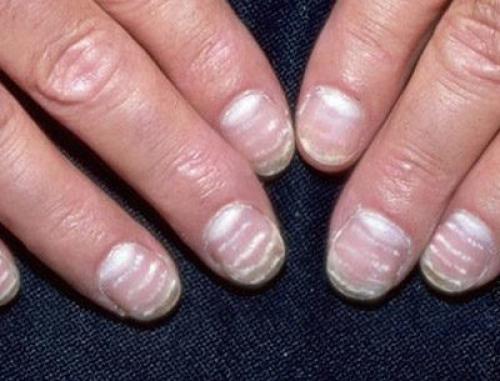 Красные полоски на ногтях после гель лака. Полоски на ногтях