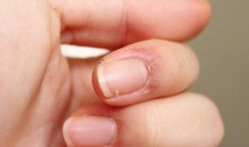 Что делать если сохнет кожа вокруг ногтей. Очень сухая кутикула