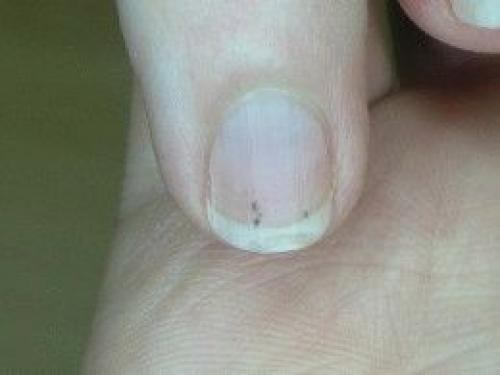 Черное пятно под ногтем: причины и возможные диагнозы