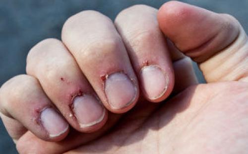 Очень сохнет кутикула и кожа вокруг ногтей на руках. Очень сухая кутикула