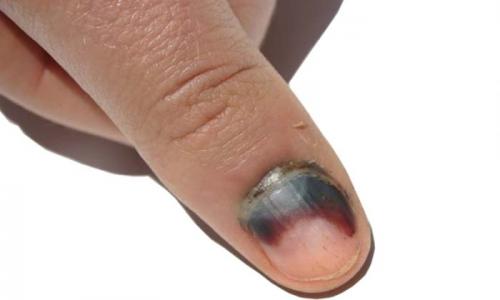 Что могут значить чёрные точки на ногтях?